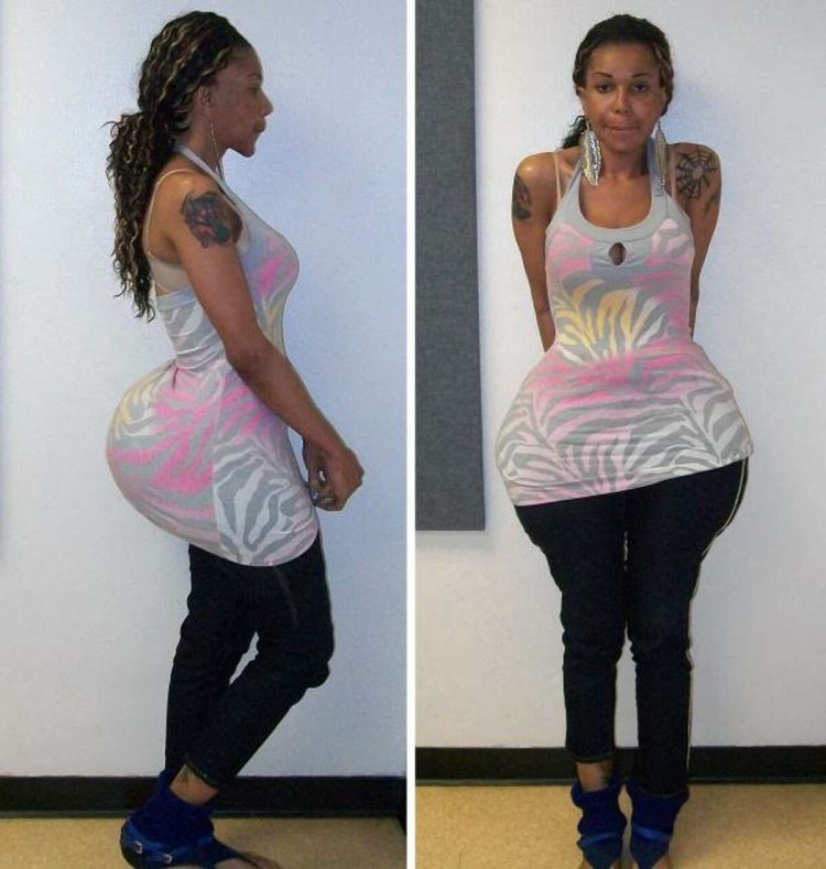 Пластическое увеличение попы