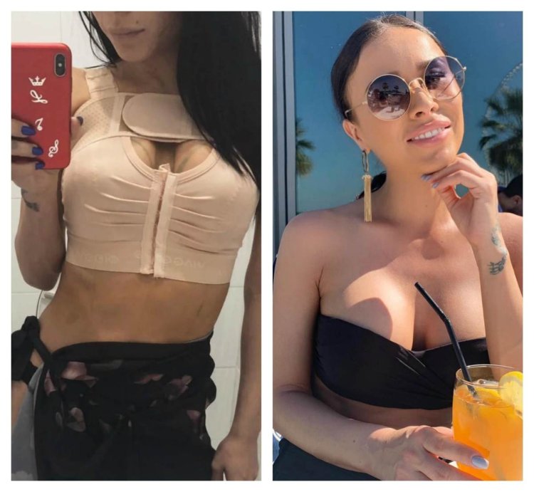 Импланты ментор 315 мл анатомы