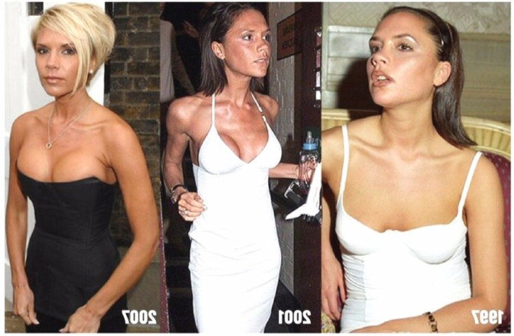 Виктория Бекхэм маммопластика