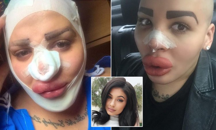 Импланты для увеличения губ