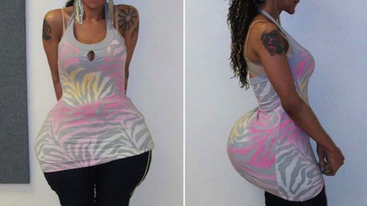 Силикон в ягодицах