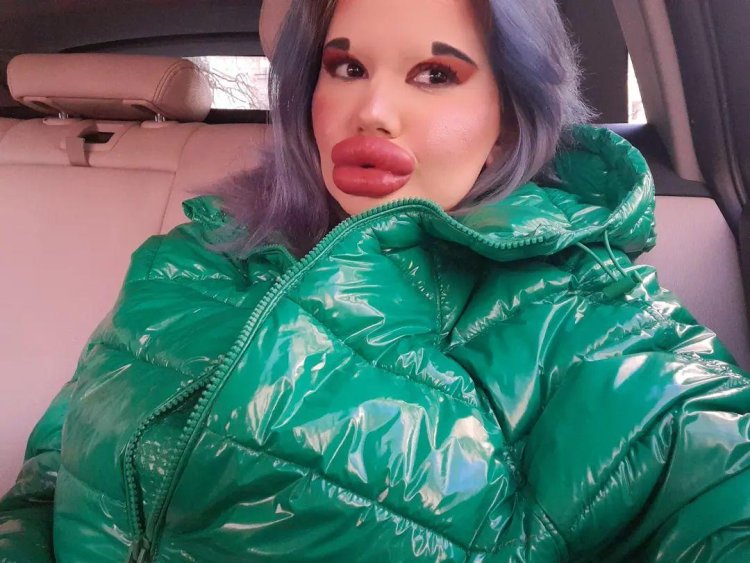 Девушка с самыми большими губами мире