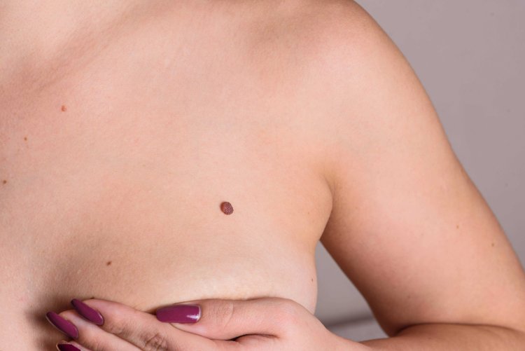 Красивые родинки на теле