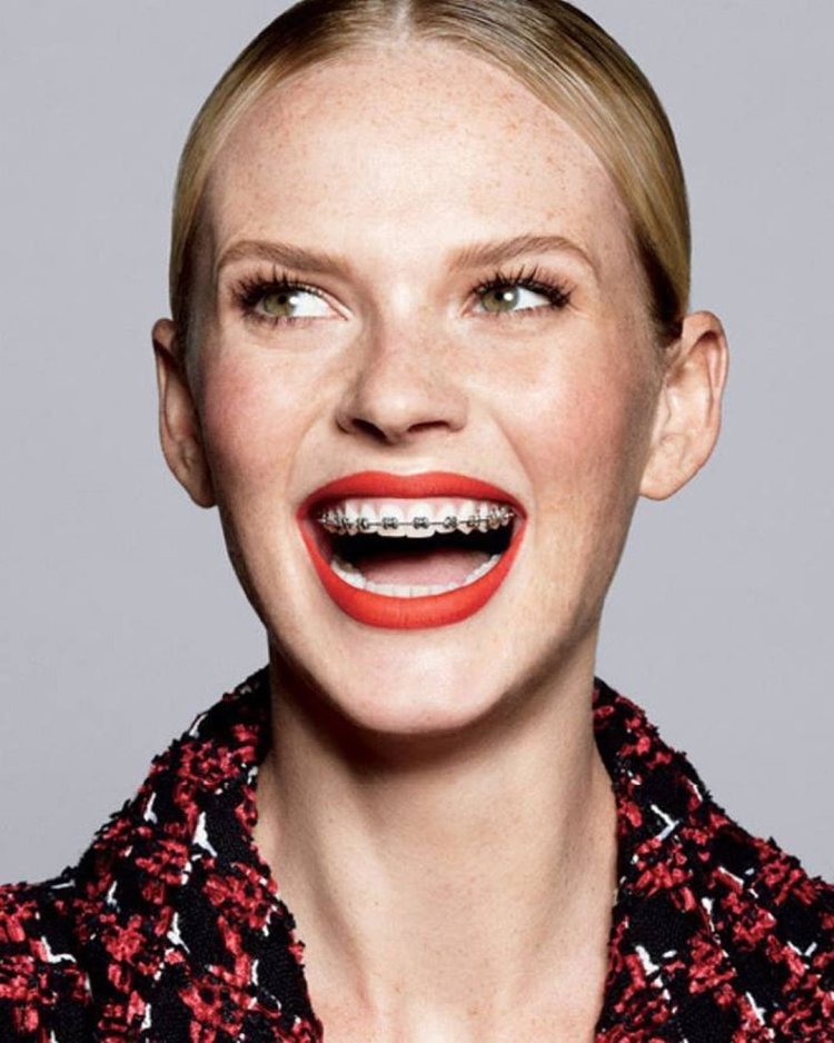 Красивые девушки с брекетами