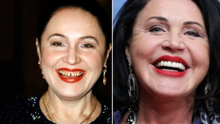 Надежда Бабкина виниры