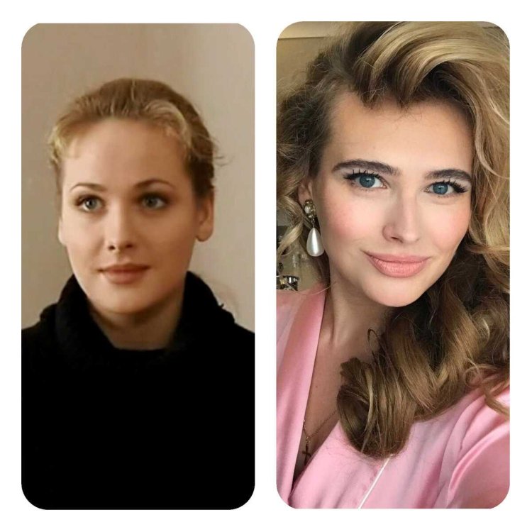 Анна Горшкова до пластики