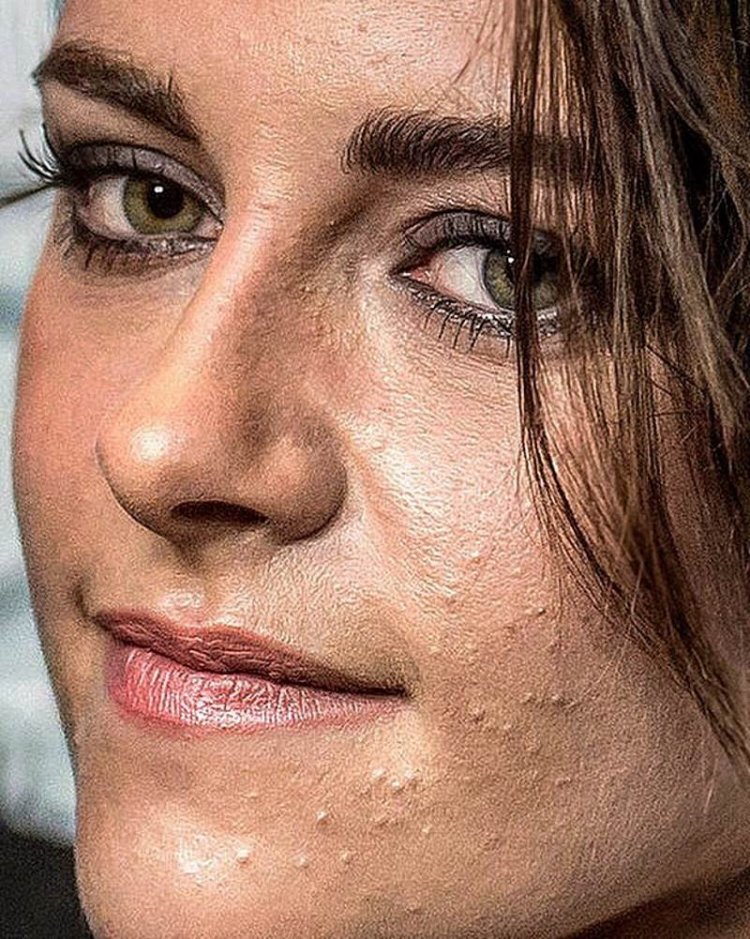 Кира Найтли прыщи