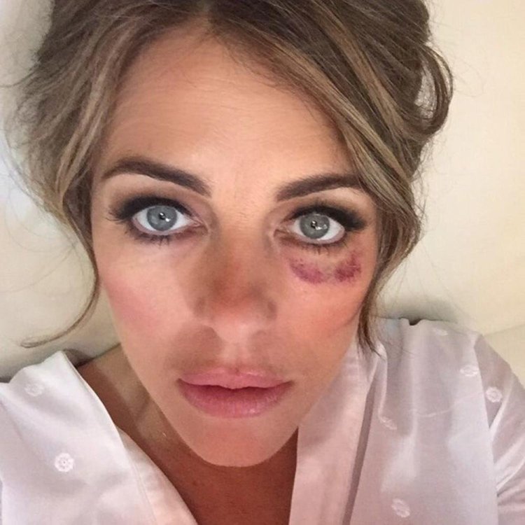 Элизабет Хёрли с фингалом