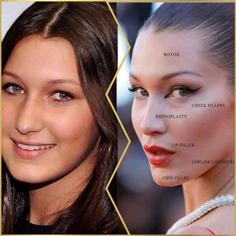 Белла Хадид до пластики