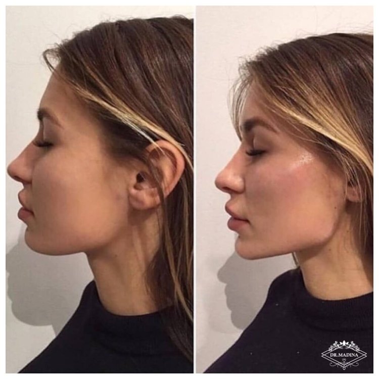 Скулы Джоли филлерами