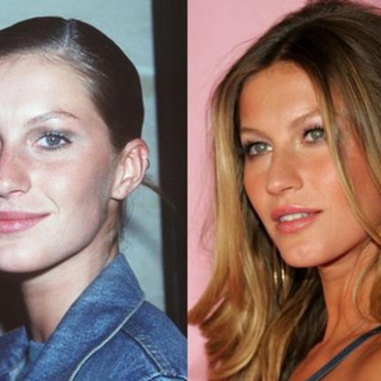 Ринопластика Жизель Бундхен