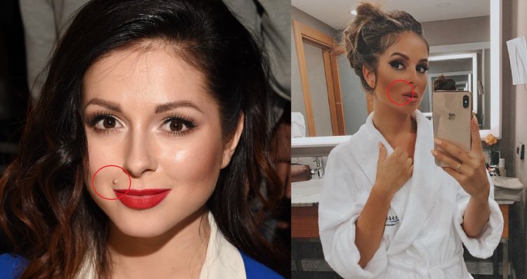 Жасмин ринопластика