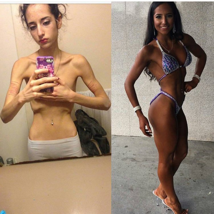 Девушки победившие анорексию