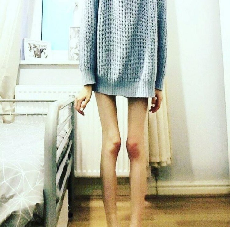 Мишель алессандра анорексия