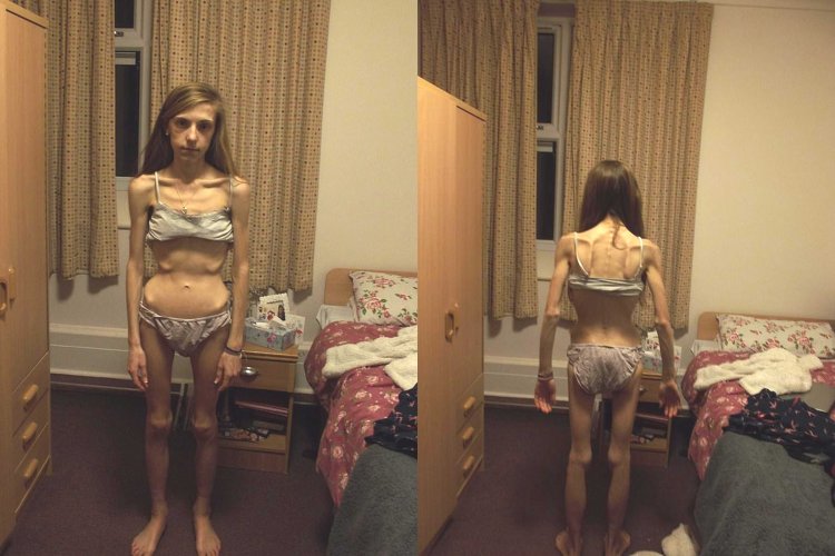 Девушки после анорексии