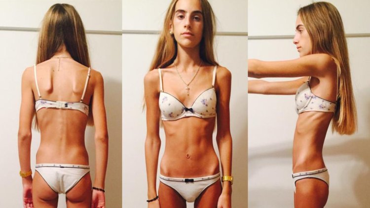 Ксения Князева Анорексичка