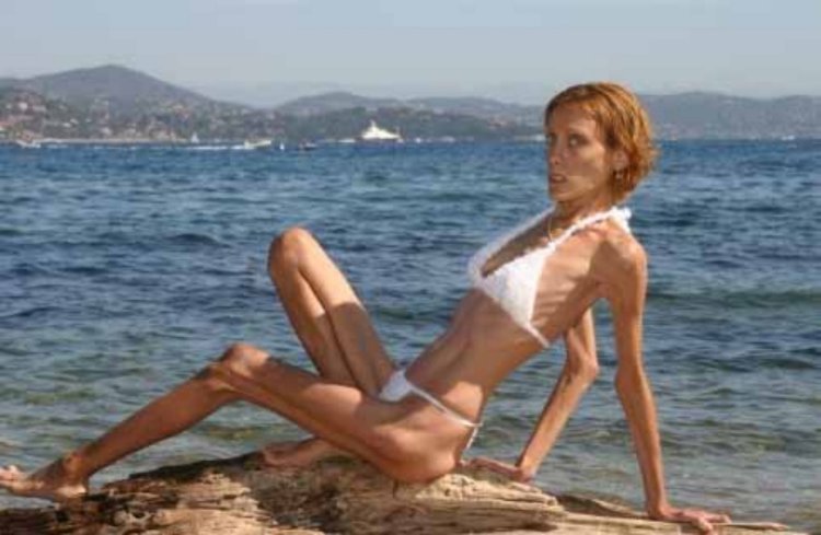 Изабель Каро анорексия