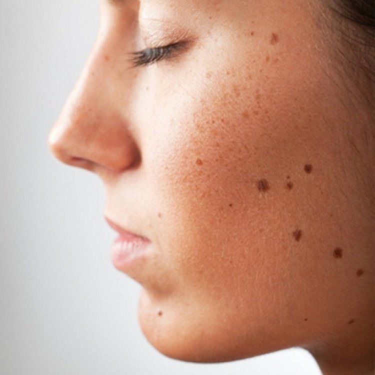 Родинка на лице