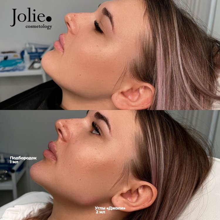 Опущенная нижняя челюсть