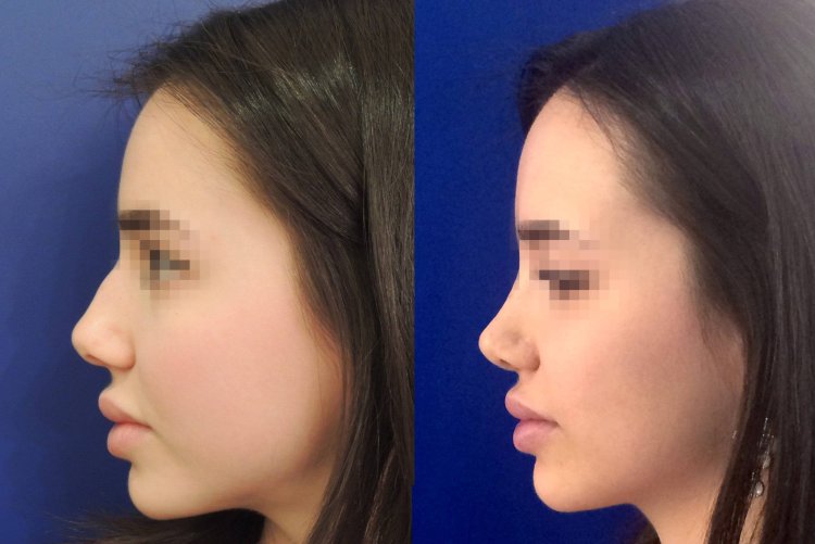 Бейби нос ринопластика