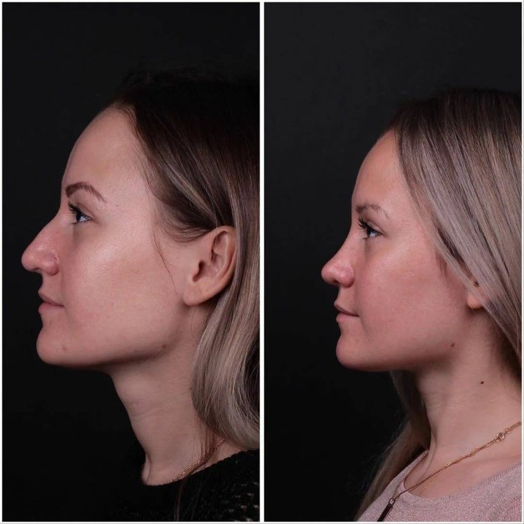 Тео ринопластика