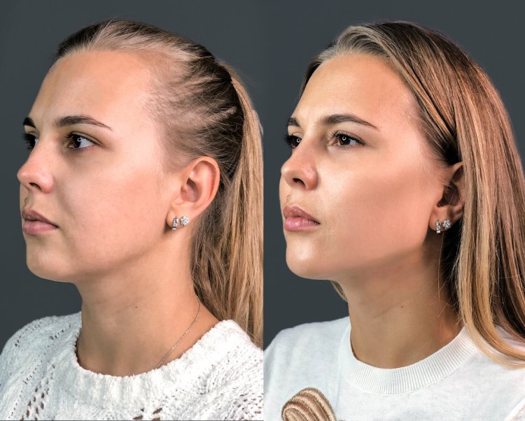 Коррекция подбородка