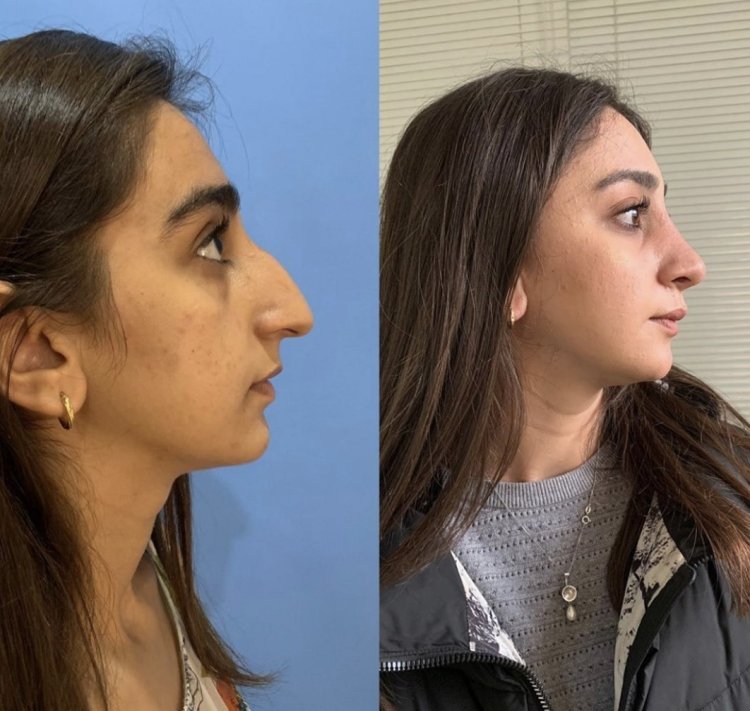 Нос с горбинкой у девушки