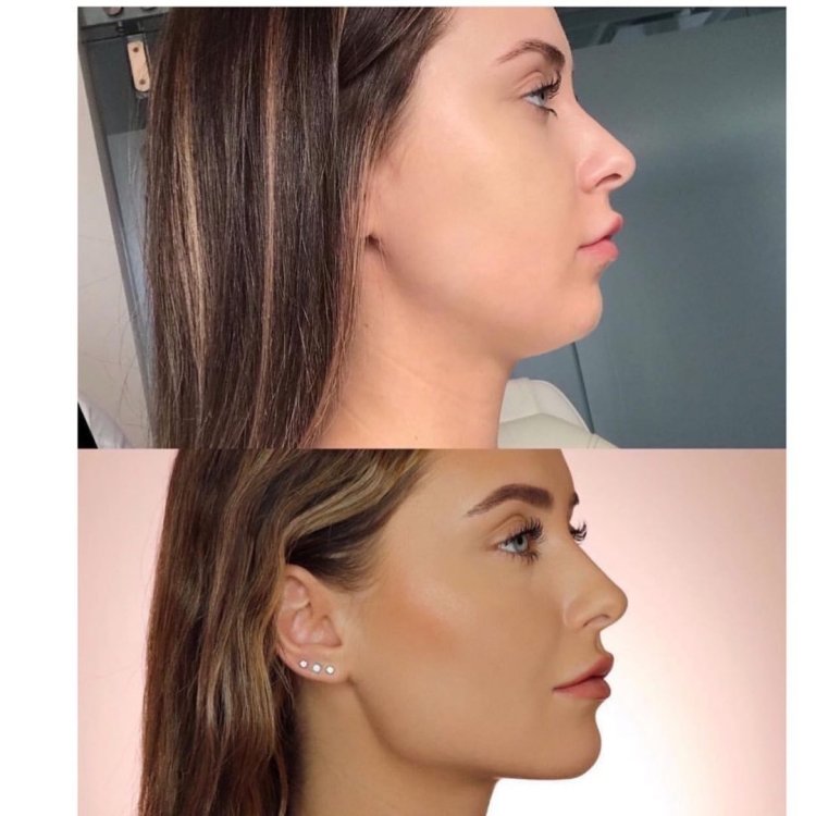 Профиль Джоли - углы нижней челюсти