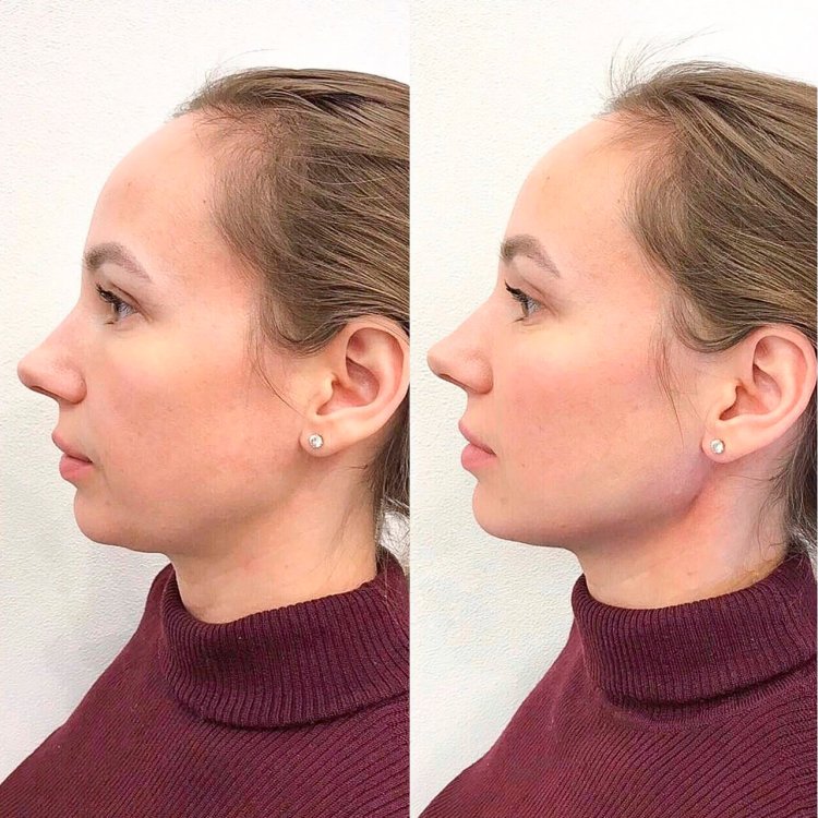 Контурная пластика подбородка филлерами