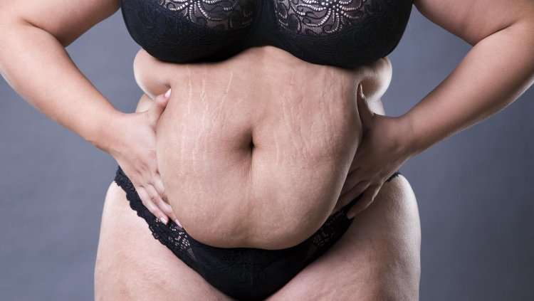 Женщина полная с обвисшей