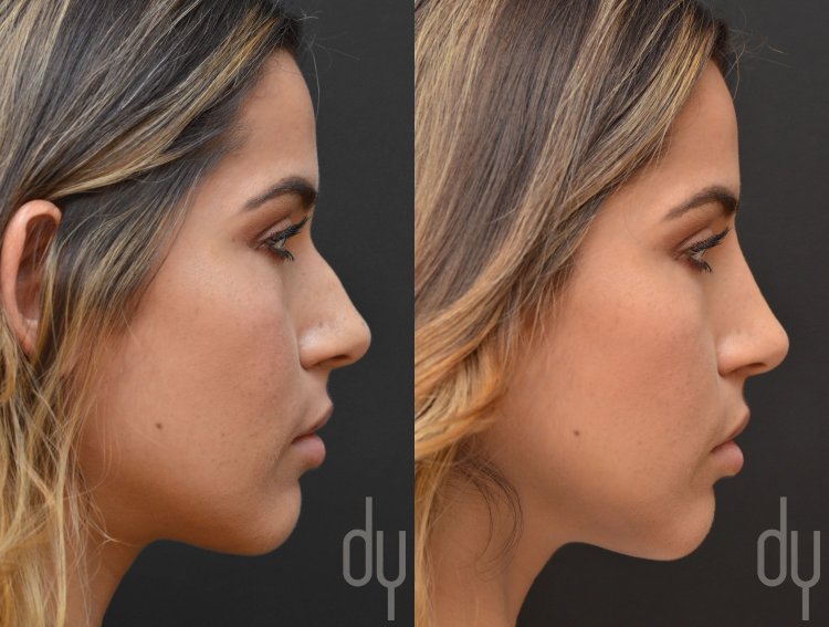 Нос с горбинкой фото