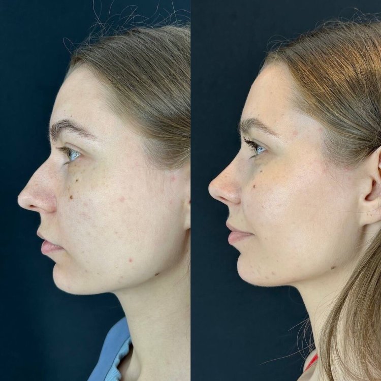 Гасан ашаханович риносептопластика