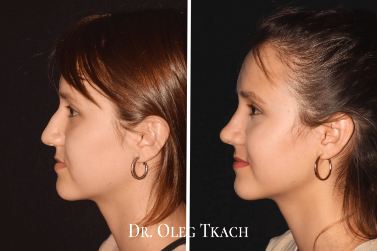 Маленький нос с горбинкой