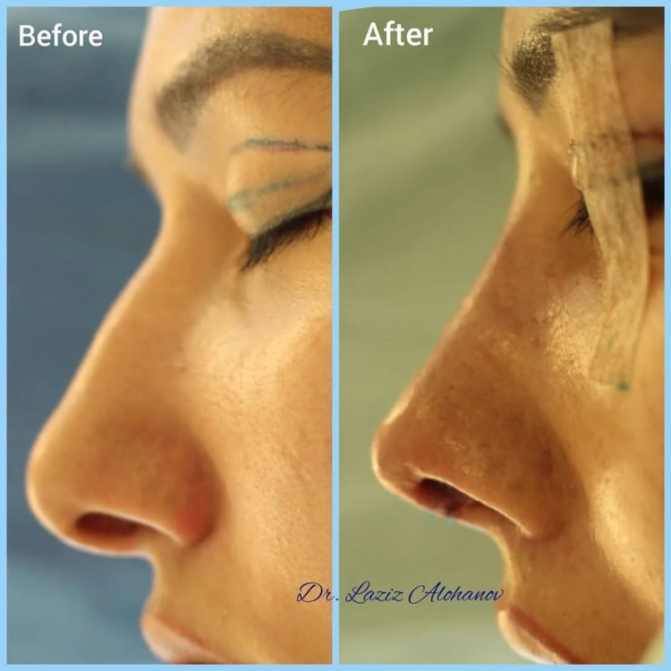 Операция носа горбинка носа