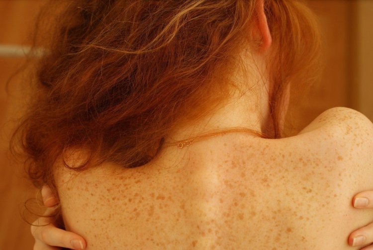 Солнечное лентиго кожи