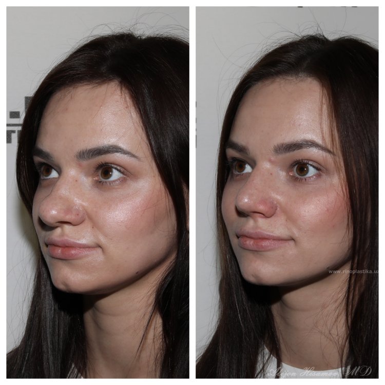 Гасан ашаханович риносептопластика