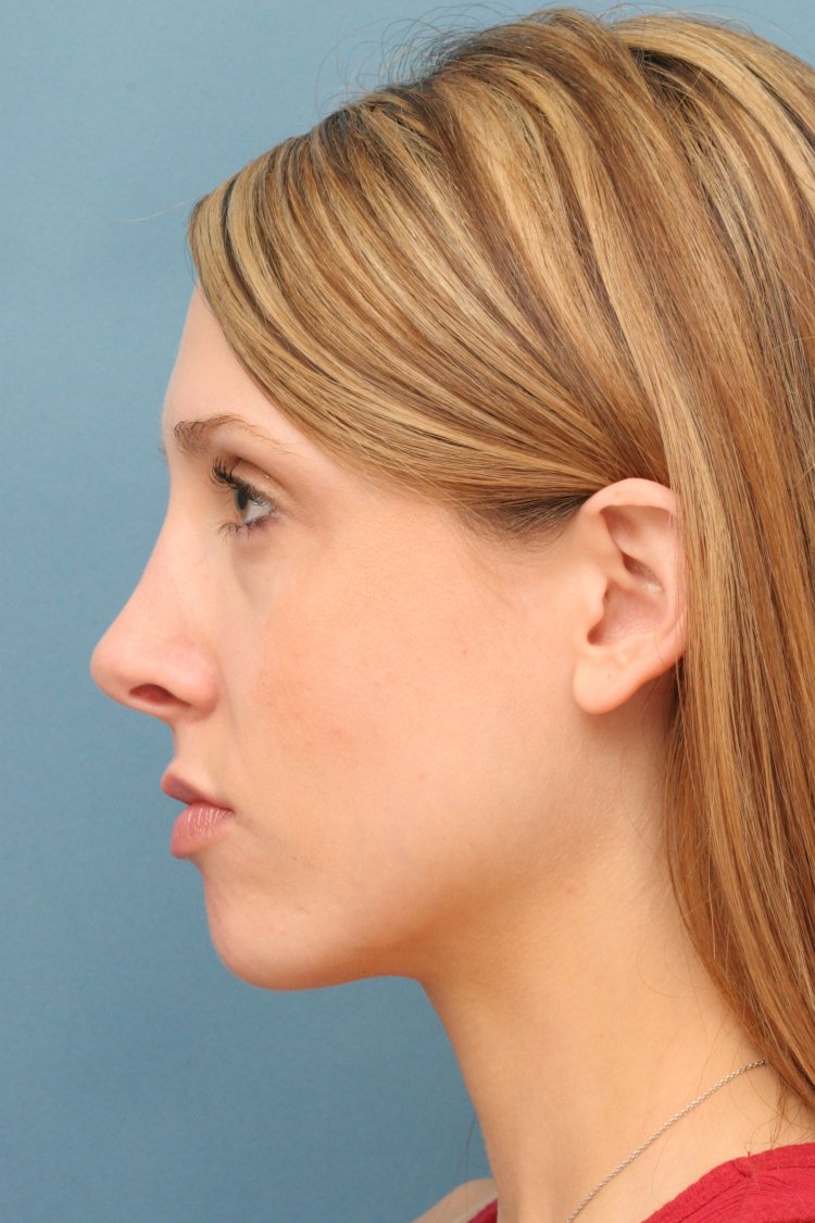 Вогнутый подбородок