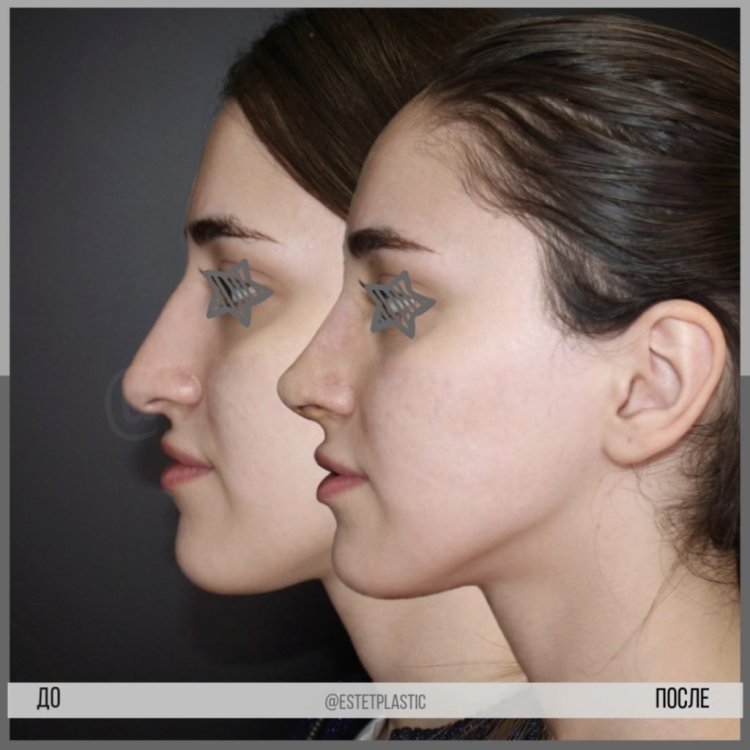 До и после ринопластики носа