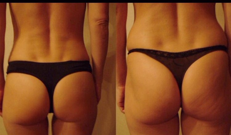 Антицеллюлитный массаж до и после 10 сеансов