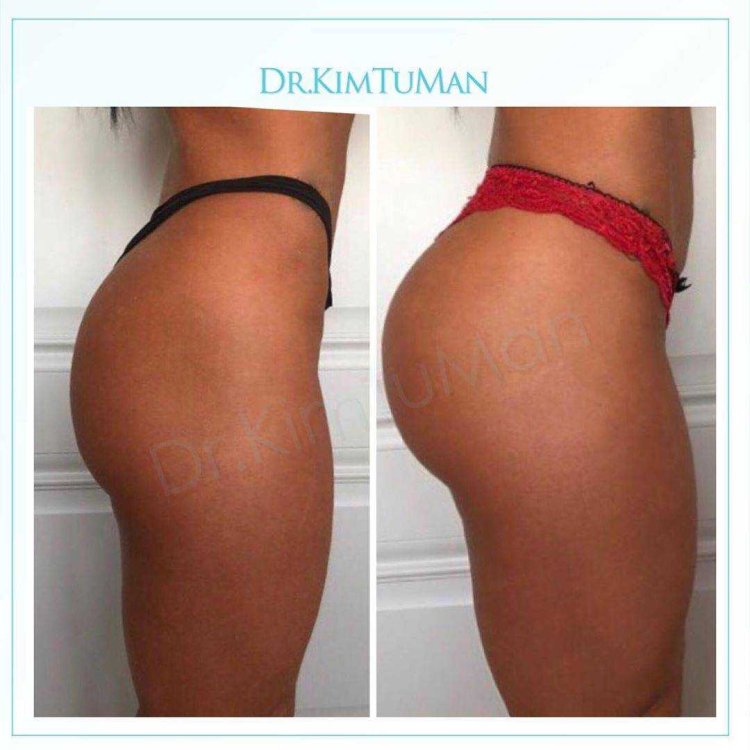 Пластика ягодиц глютеопластика