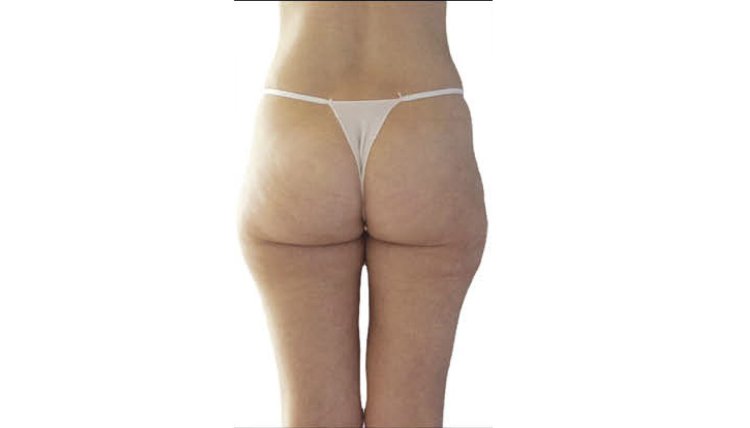 Целлюлит на попе