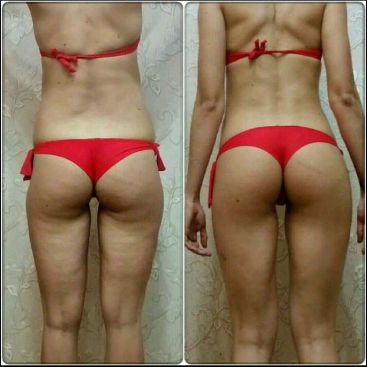 Рыхлые ягодицы