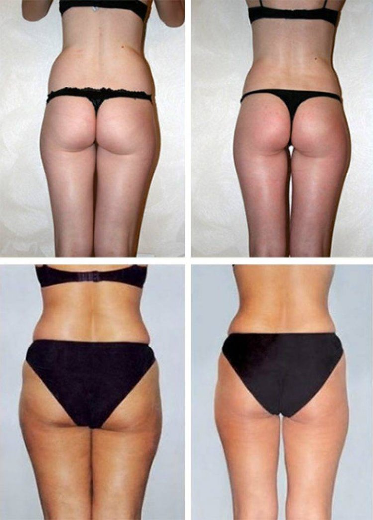 Миостимуляция галифе