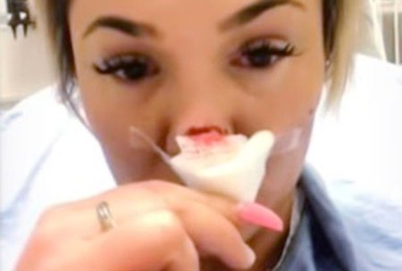 Парень откусил девушке нос