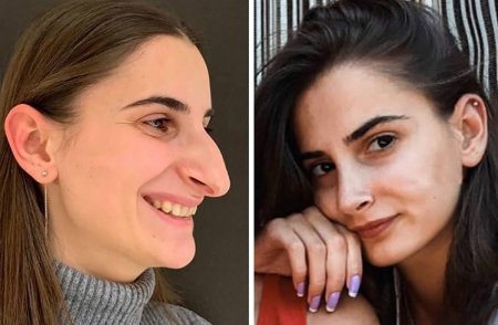 До ми после ринопластики