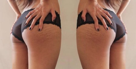 Растяжки на попе красивые