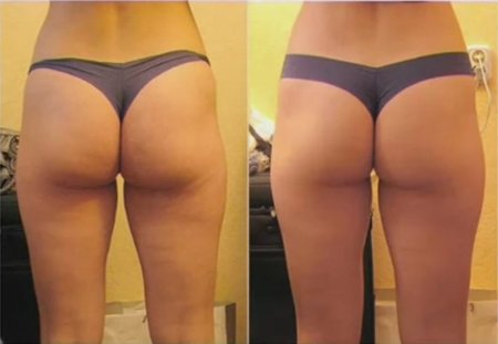 Целлюлитные ноги и ягодицы