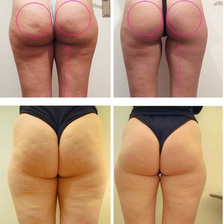 Пластика ягодиц глютеопластика