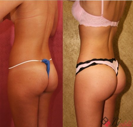 Впалые ягодицы