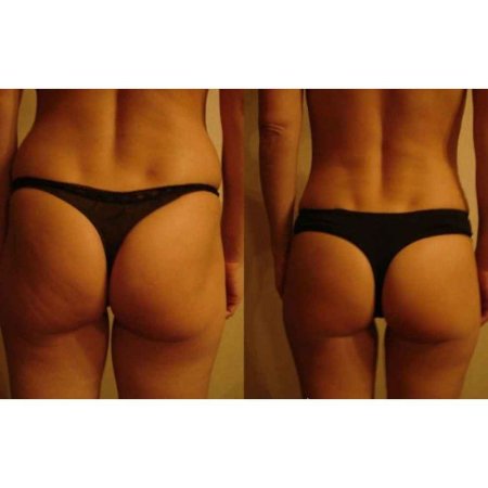 Ямочки на бедрах